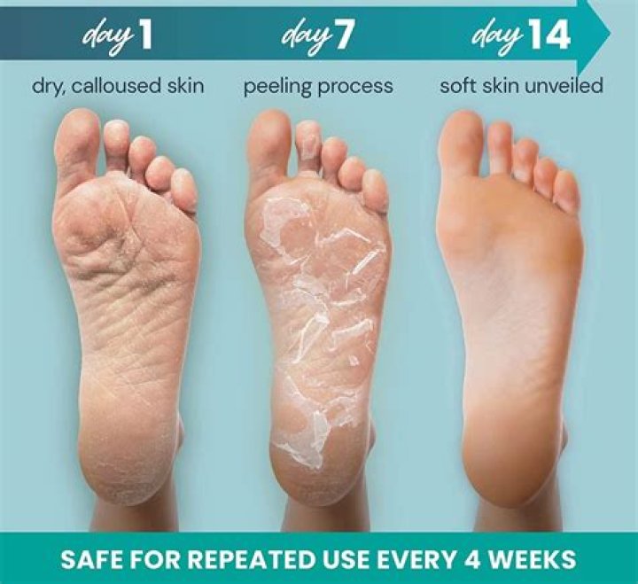 4 Reasons Your Feet Are Peeling