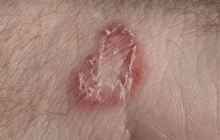 5 Nasty Skin Conditions You Can Pick Up At the Gym