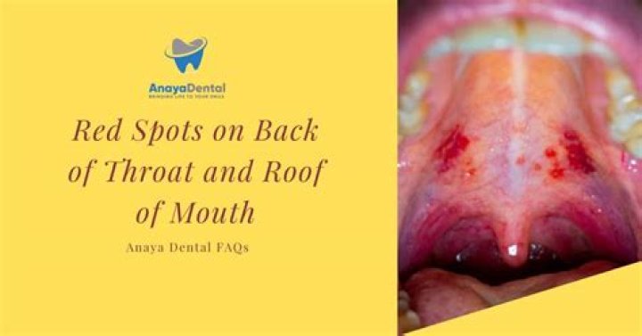 Can You Bruise The Back Of Your Throat From Oral