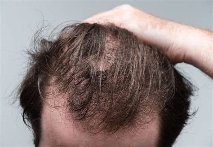 Definitions of balding pate - OneLook