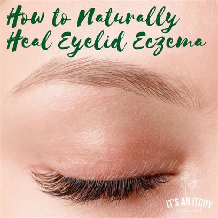 Eye eczema treatment | How to soothe itchy, flaky skin around the eyes