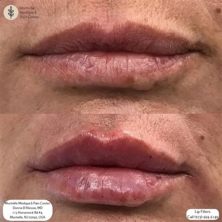 Farrah Abraham Opens Up on Failed Lip Injection