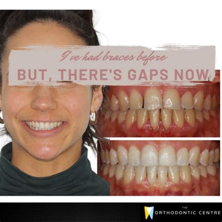Gap Between Front Teeth: Find Out whether the Gap Between Front teeth is lucky or not!