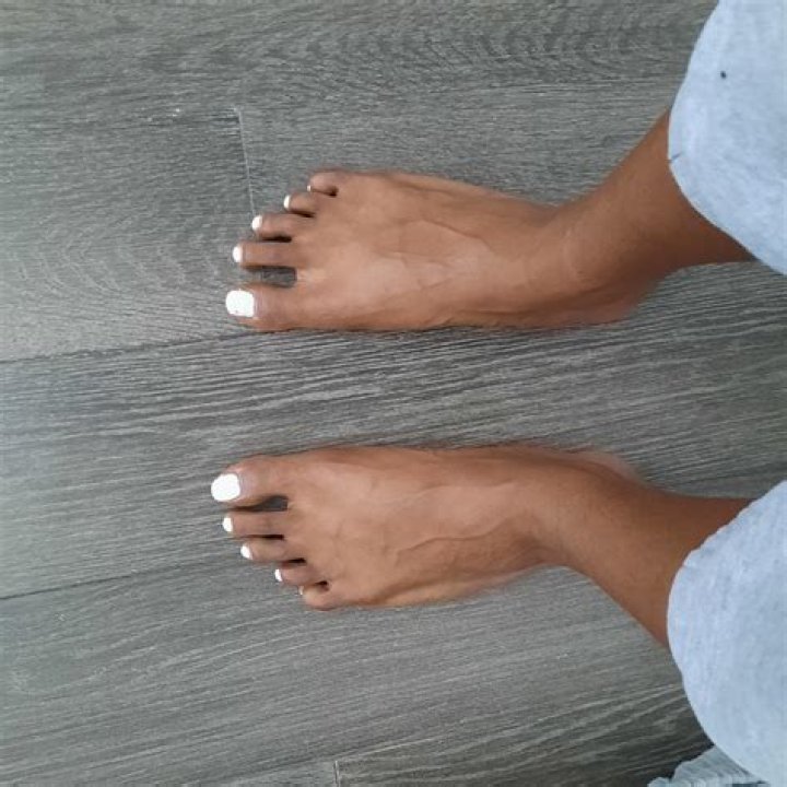 Is It Normal For Your Pinky Toe To Be Sideways