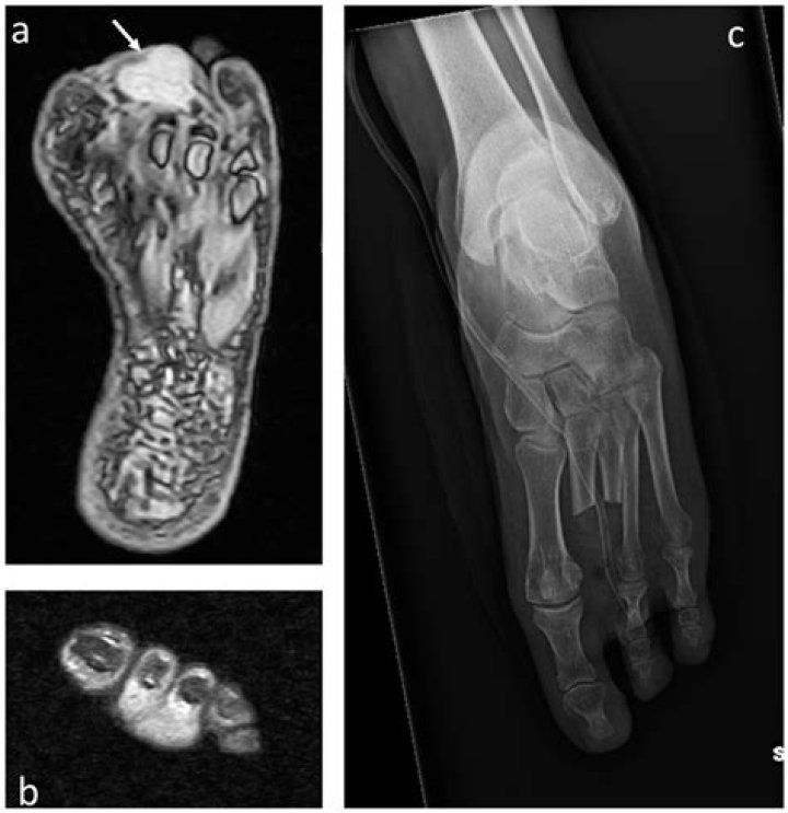 Is The Daylyt Feet Picture Real? What Does Arachnodactyly Mean?