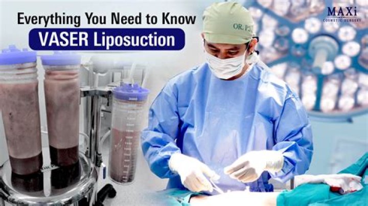 Vaser liposuction review
