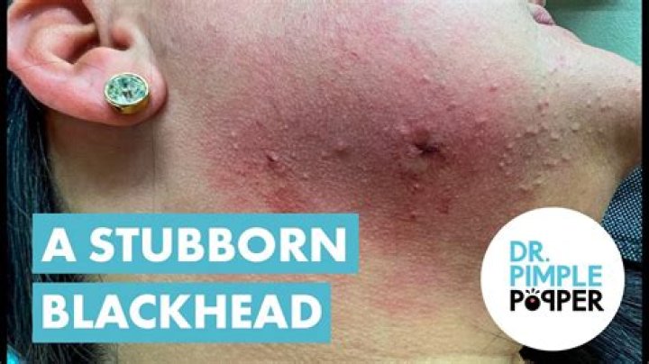 Watch Dr. Pimple Popper Pluck a Blackhead from a Patient's Eyelid