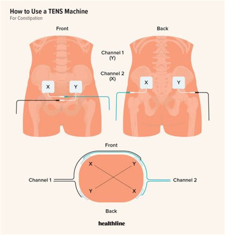 Where to Place TENS Unit for Constipation